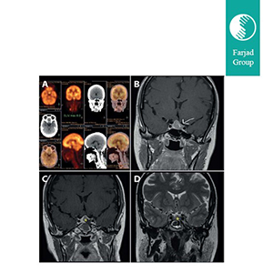 Dynamic Pituitary MRI